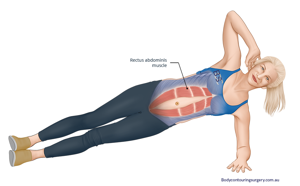 rectus abdominis muscles