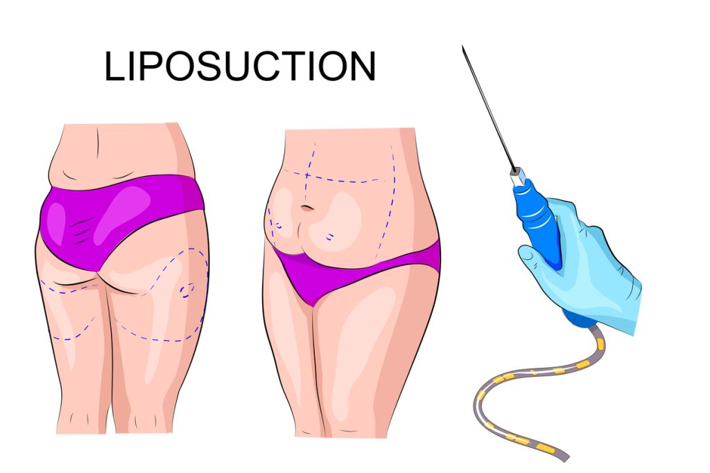 Liposuction