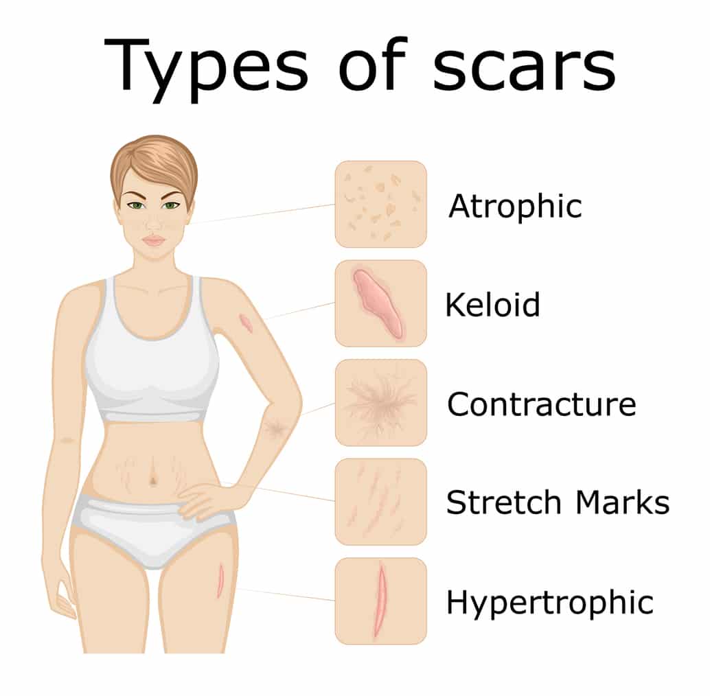 Tummy Tuck Scars