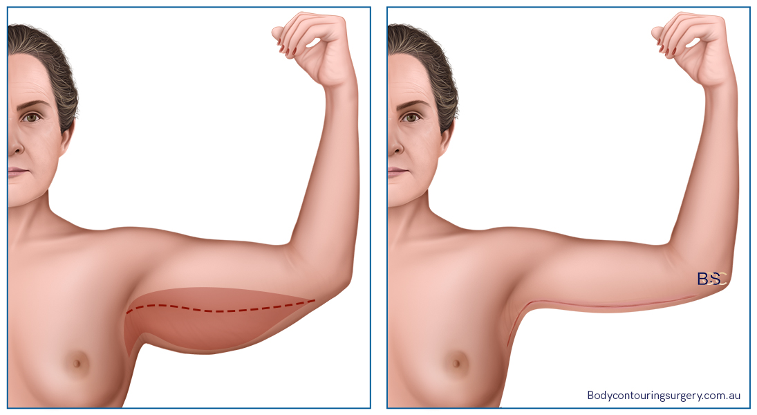 Extended brachioplasty | Body contouring surgery clinic