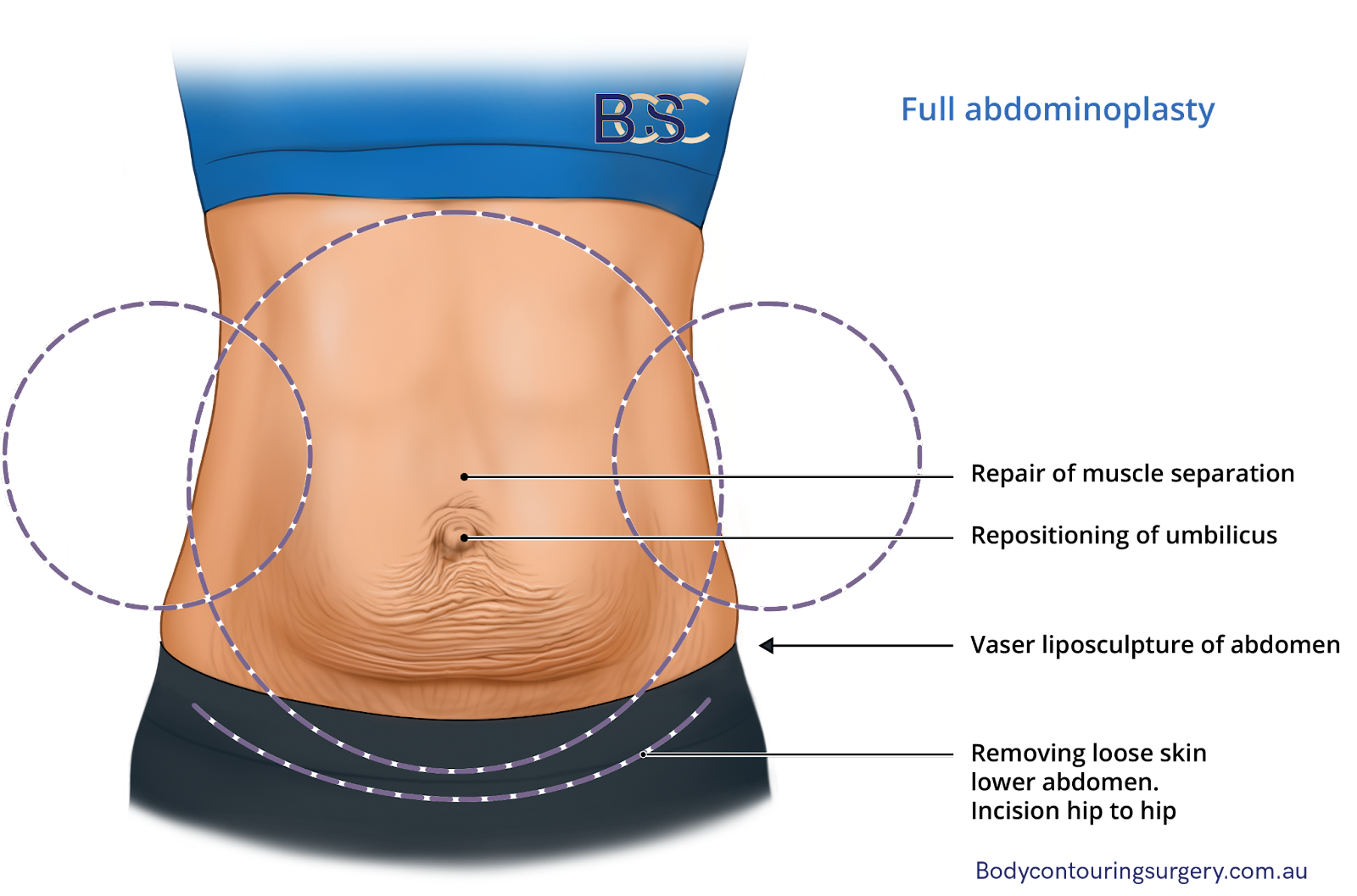 Abdominoplasty: The 3 Types of Tummy Tuck Procedures