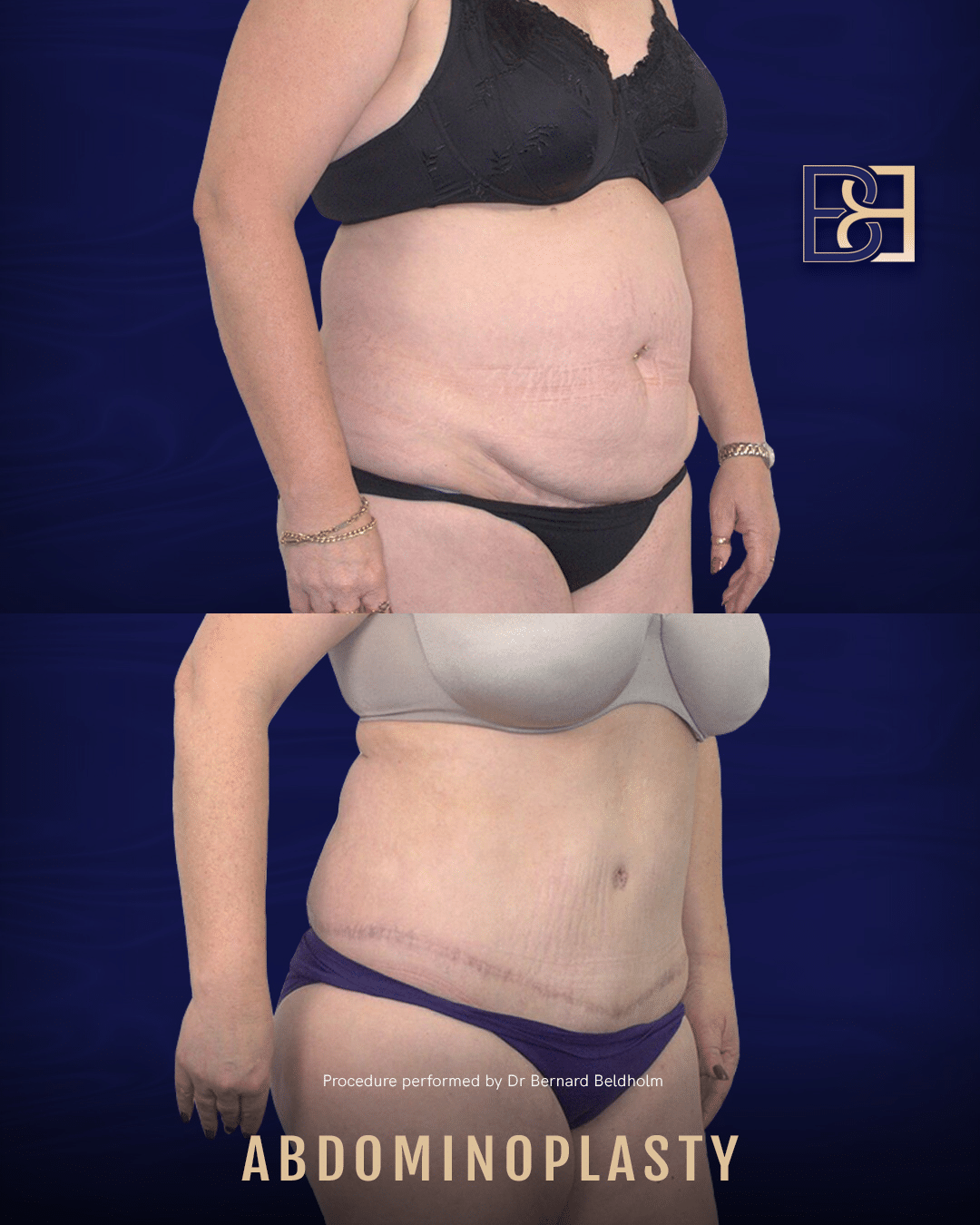Tummy Tuck 3 Week Update  Before and After Pictures & Full