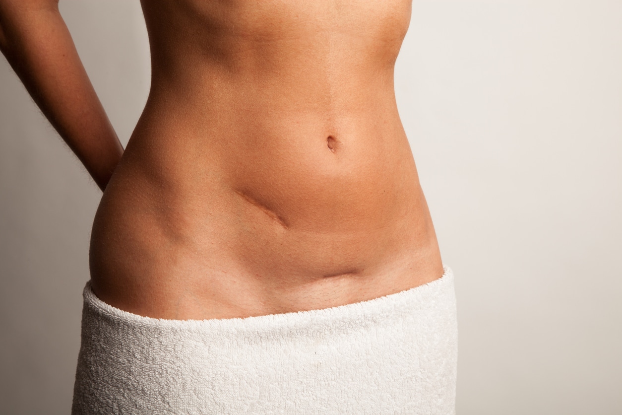 Unveiling Tummy Tuck Scars: What to Expect and Where - Reviews