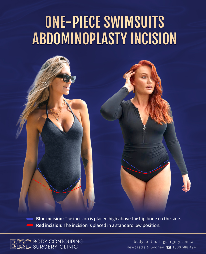 One-Piece swimsuits abdominoplasty incision | BCSC | Infographic