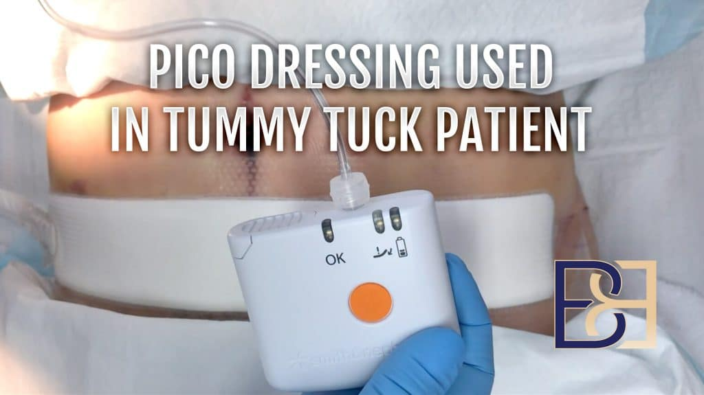 Benefits of PICO Pressure Therapy for Abdominoplasty Incision Healing