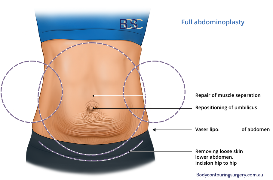 Extended Tummy Tuck, Tighten The Abdomen, Hips, & Lower Back