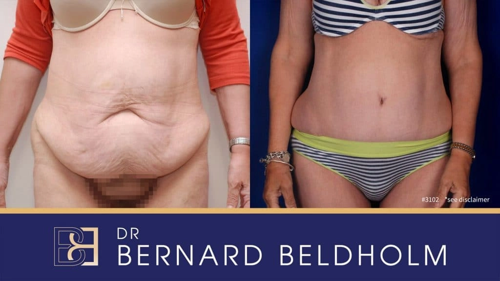 Abdominoplasty Post Weight Loss Before & After