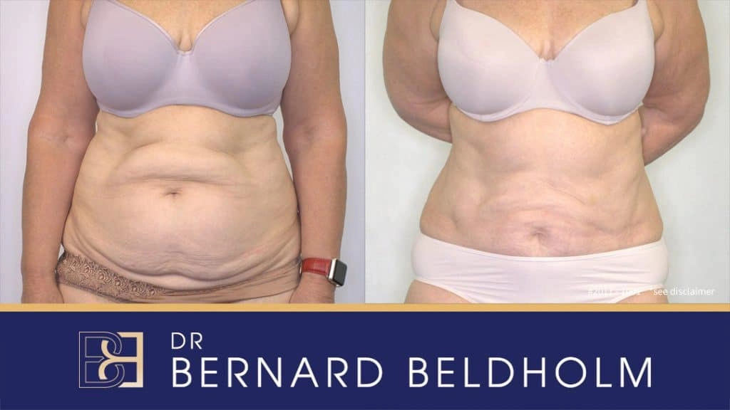 Abdominoplasty Post Pregnancy Before & After