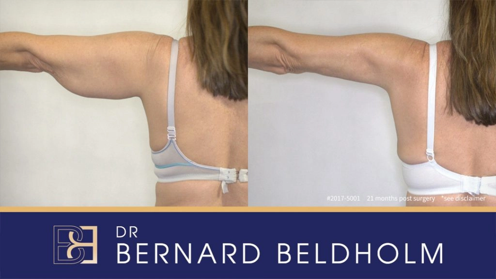Patient 2017-5001 Brachioplasty Before After