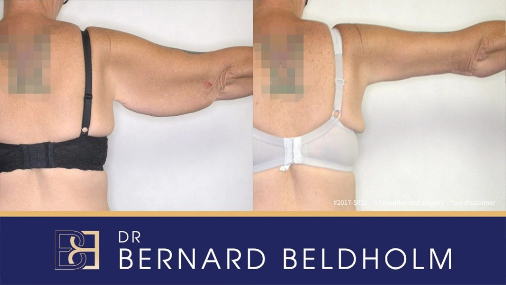 Patient 2017-5002 Brachioplasty Before After