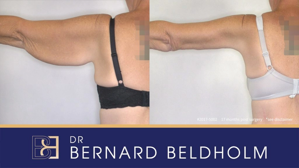 Patient 2017-5002 Brachioplasty Before After