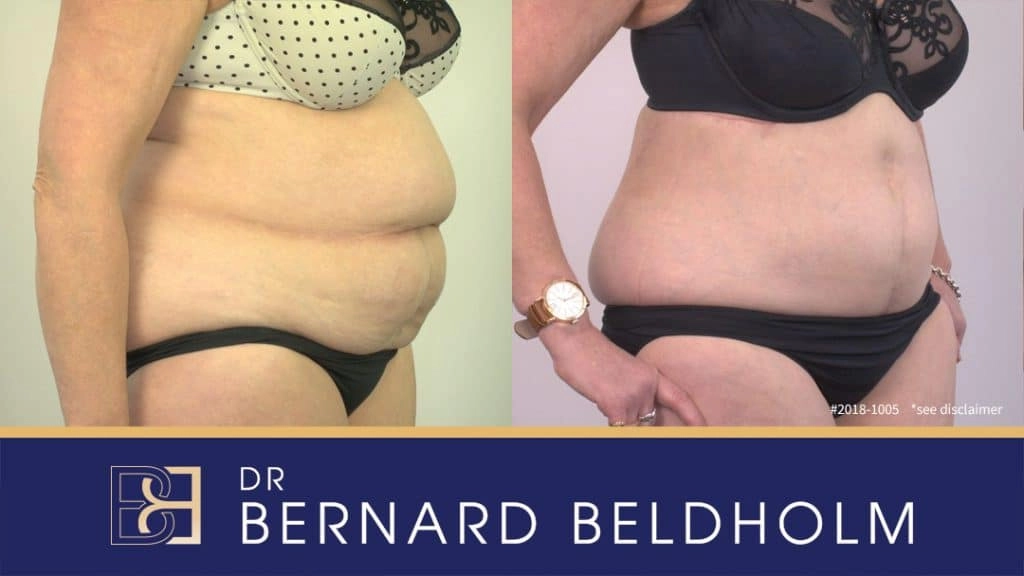 Patient 2018-1005 Reverse tummy tuck