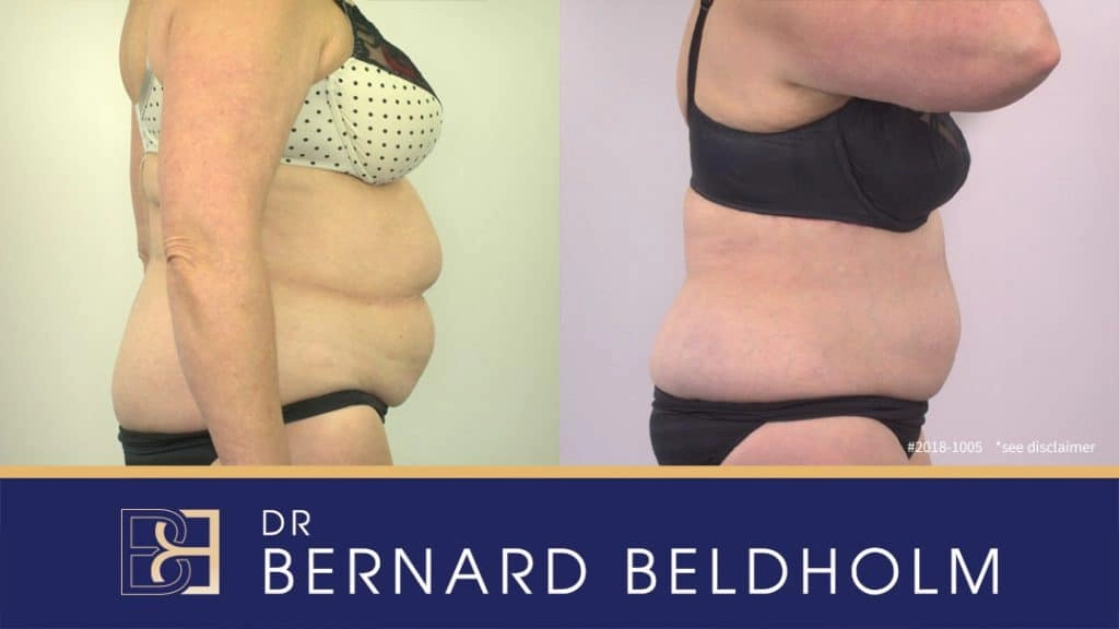 Patient 2018-1005 Reverse tummy tuck