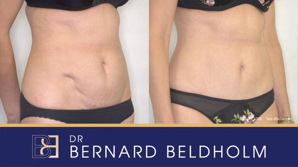 Mini Abdominoplasty Post Pregnancy Patient 2018-1006