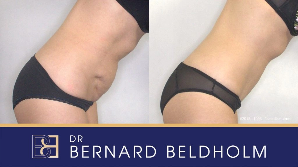 Mini Abdominoplasty Post Pregnancy Patient 2018-1006