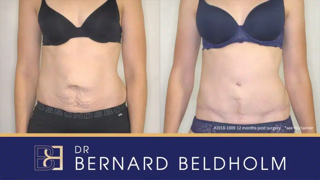 Patient 2018-1009 - Full Tummy Tuck - Before & After