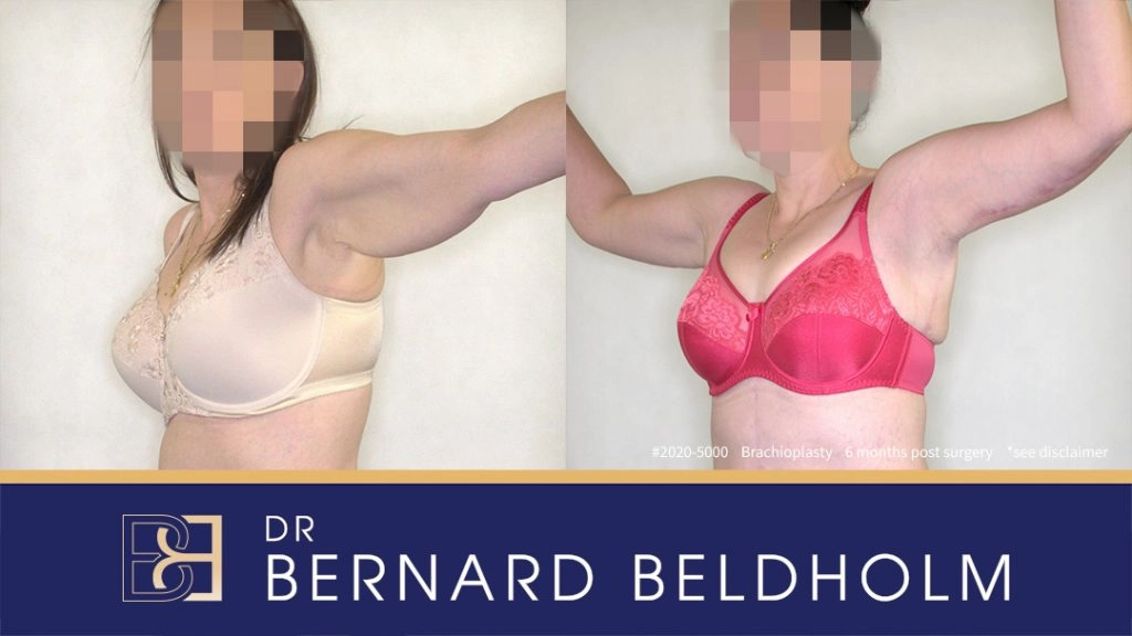 Patient 2020-5000 Brachioplasty Before After