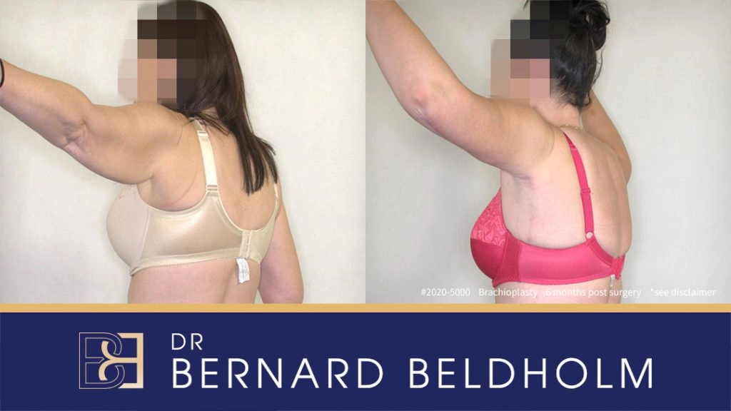 Patient 2020-5000 Brachioplasty Before After