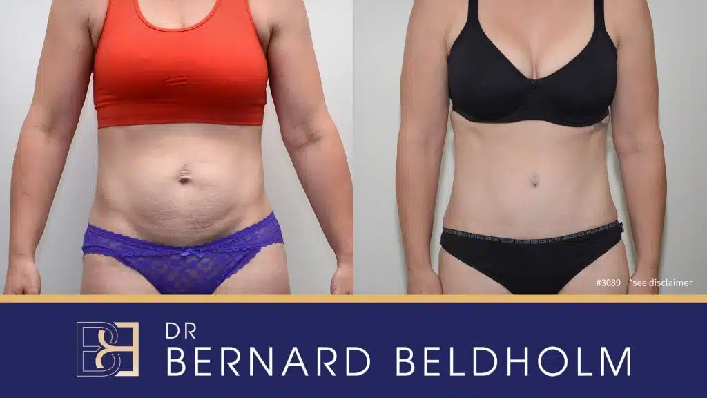 Patient 3089 - Before & After Abdominoplasty