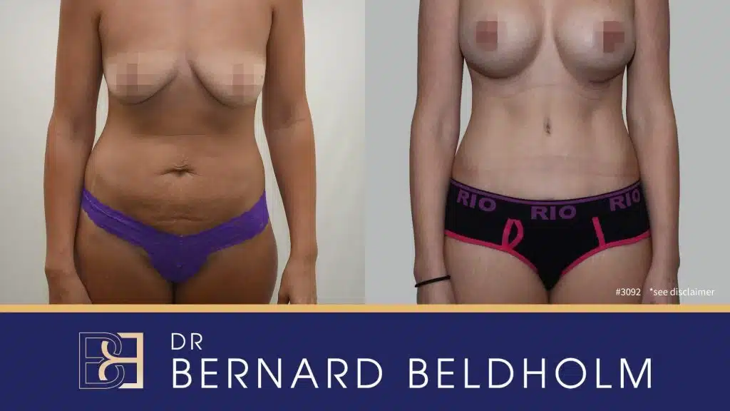 Patient 3092 - Before & After Abdominoplasty