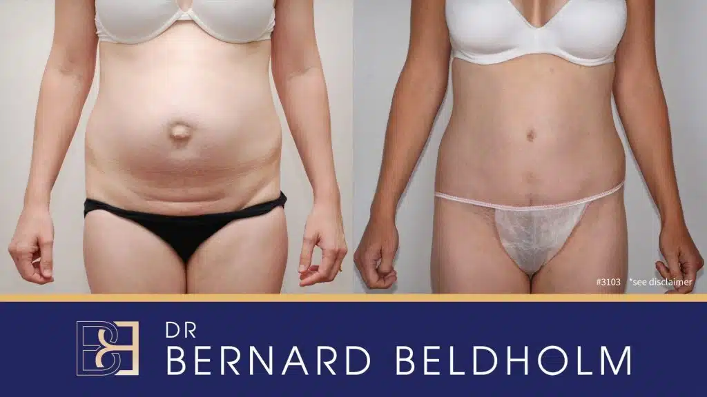 Patient 3103 - Before & After Abdominoplasty