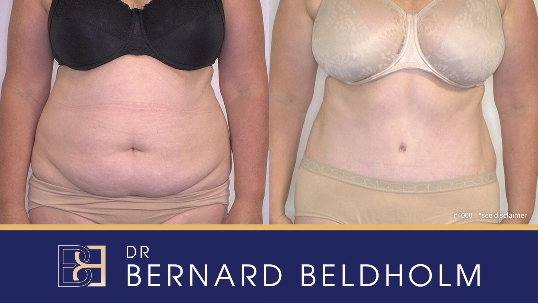 Patient 4000 - Tummy Tuck - Before & After