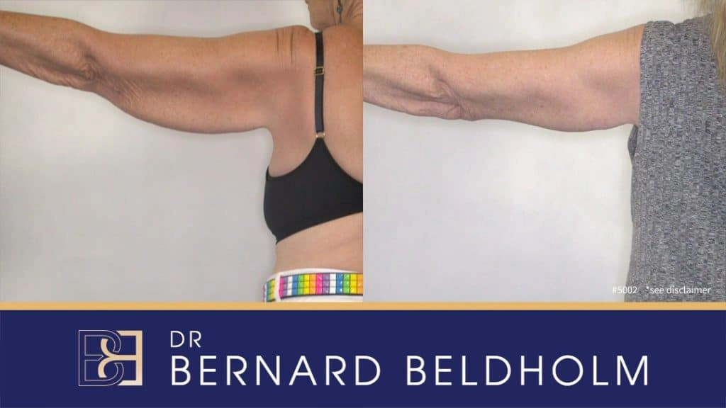 Patient 5002 Arm Lift Before After