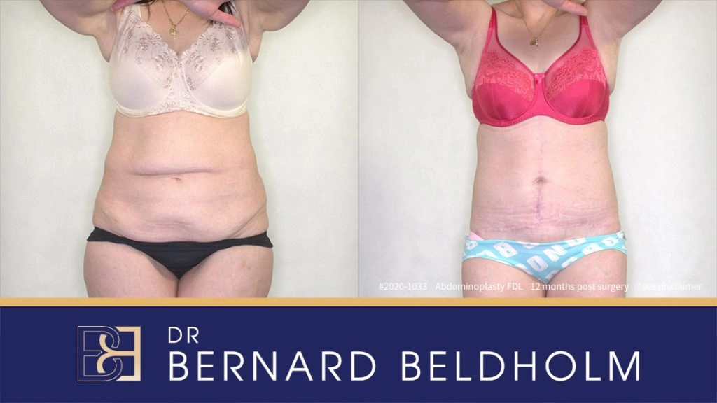 Fleur de Lis Turkey - Tummy Tuck is your best option after weight loss