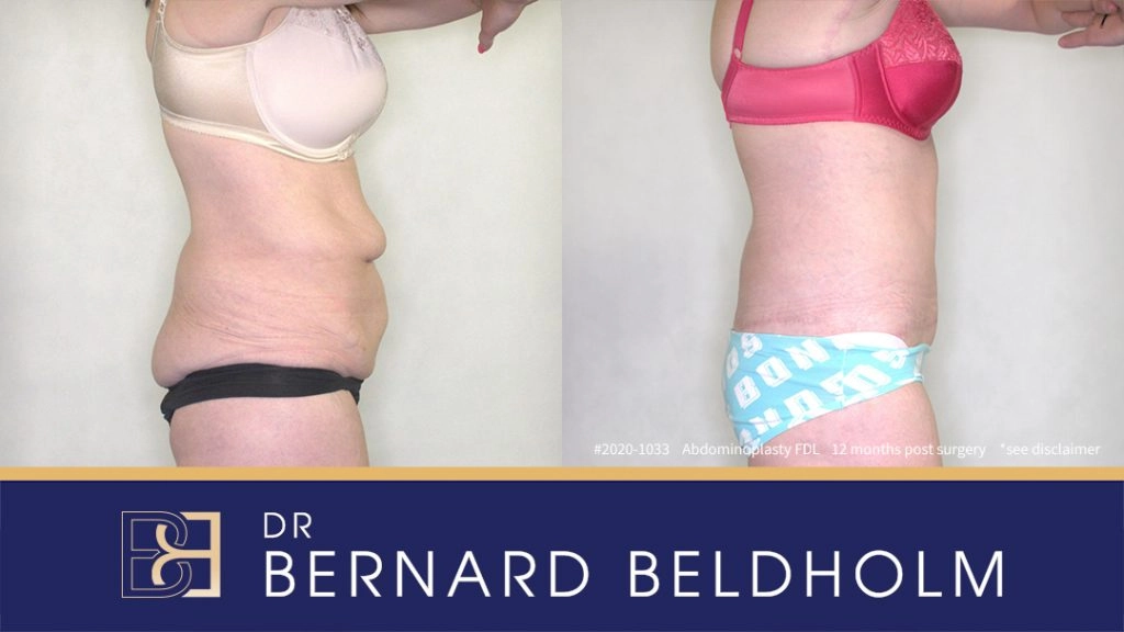 Fleur-De-Lis Abdominoplasty Post Weight Loss Patient 2020-1033