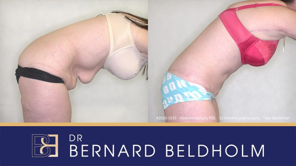 Fleur-De-Lis Abdominoplasty Post Weight Loss Patient 2020-1033