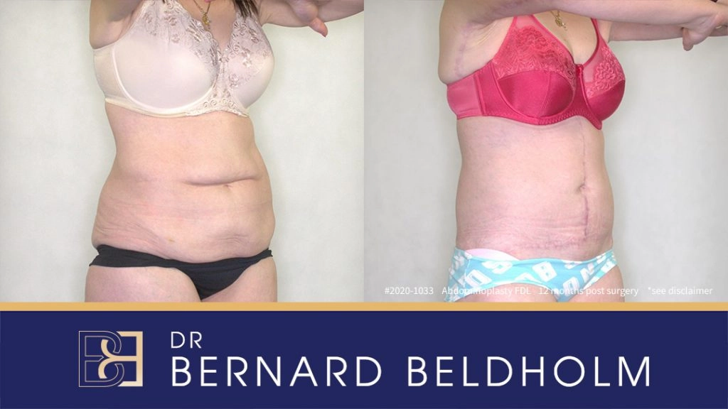 Fleur-De-Lis Abdominoplasty Post Weight Loss Patient 2020-1033
