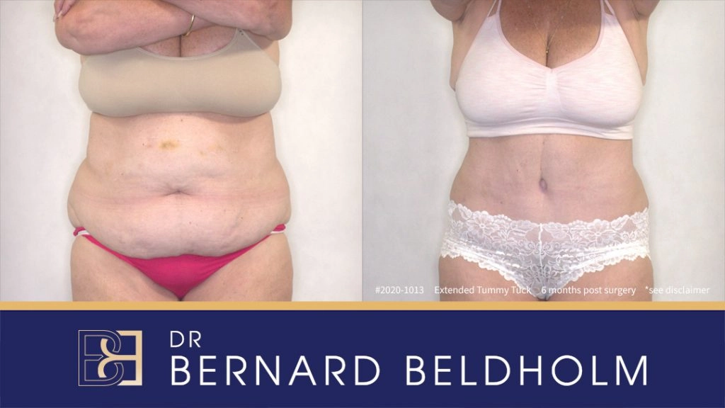 Abdominoplasty Post Weight Loss Before & After