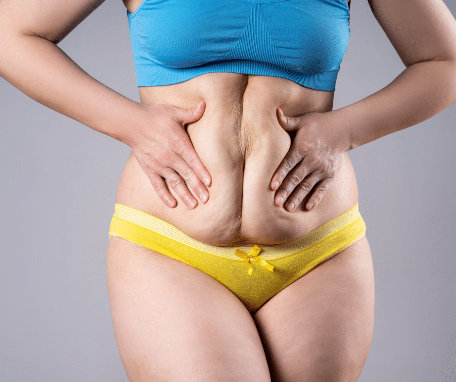 Post-Bariatric Body Contouring Surgeries