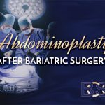 Abdominoplasty After Bariatric Surgery