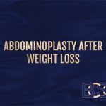 Abdominoplasty After Weight Loss