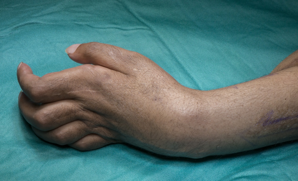 Wrist fusion for Volkmann's ischaemic contracture (Using Synthes fusion  plate) Surgical Technique - OrthOracle