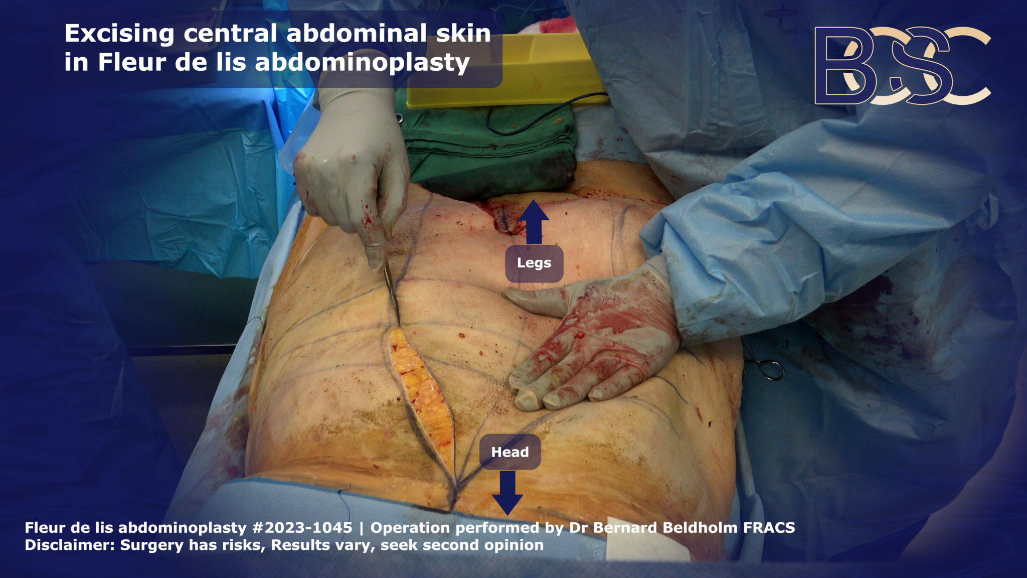 Excision of central abdominal skin in Fleur de lis abdominoplasty | BCSC