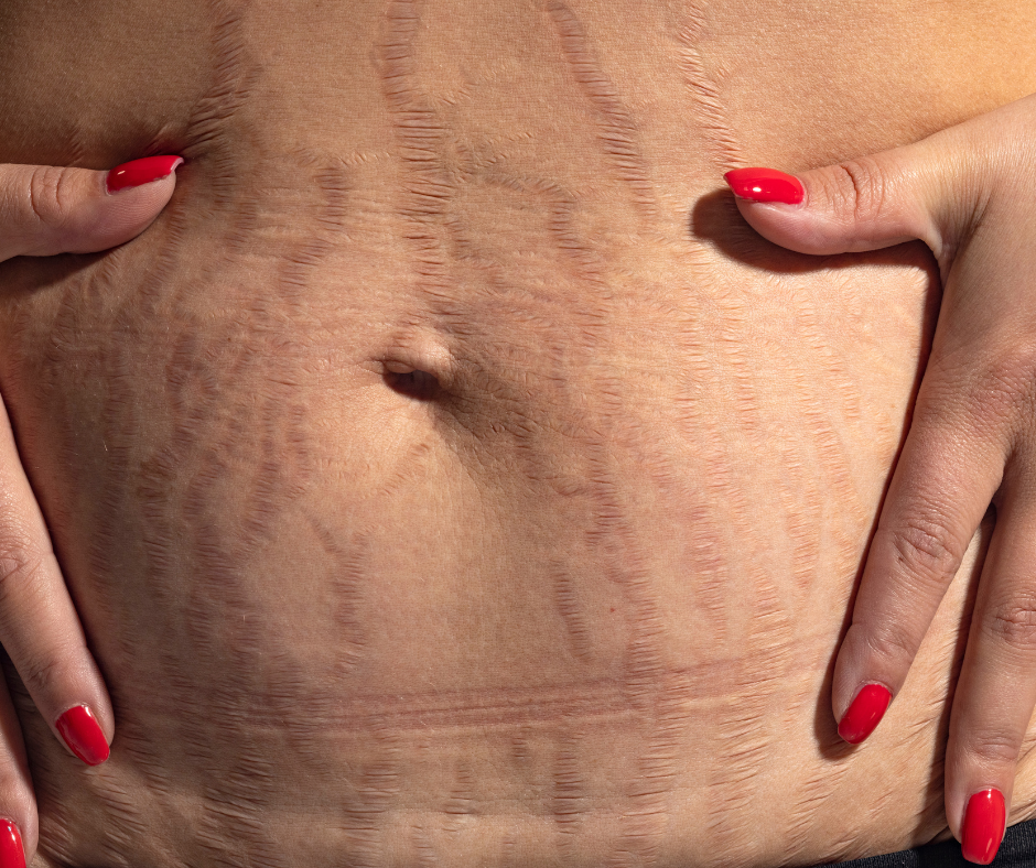 many new moms develop stretch marks once returning to a healthy weight