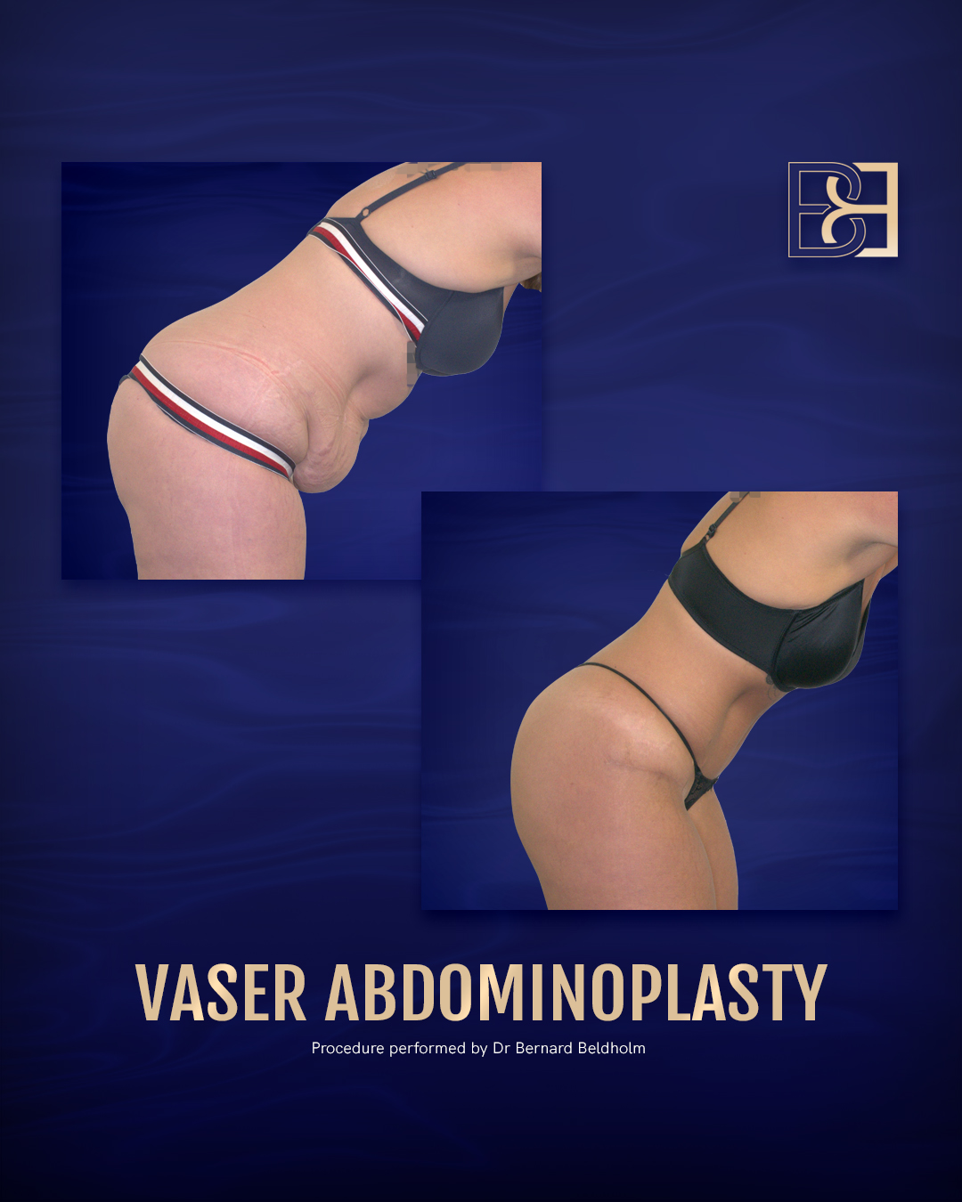 B&A abdominoplasty post pregnancy | BCSC