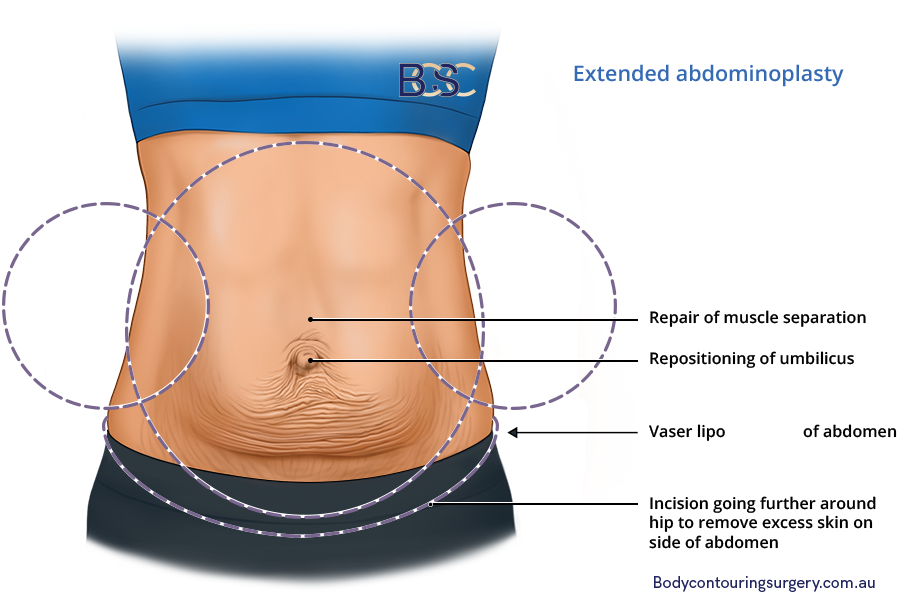 Extended abdominoplasty | BCSC