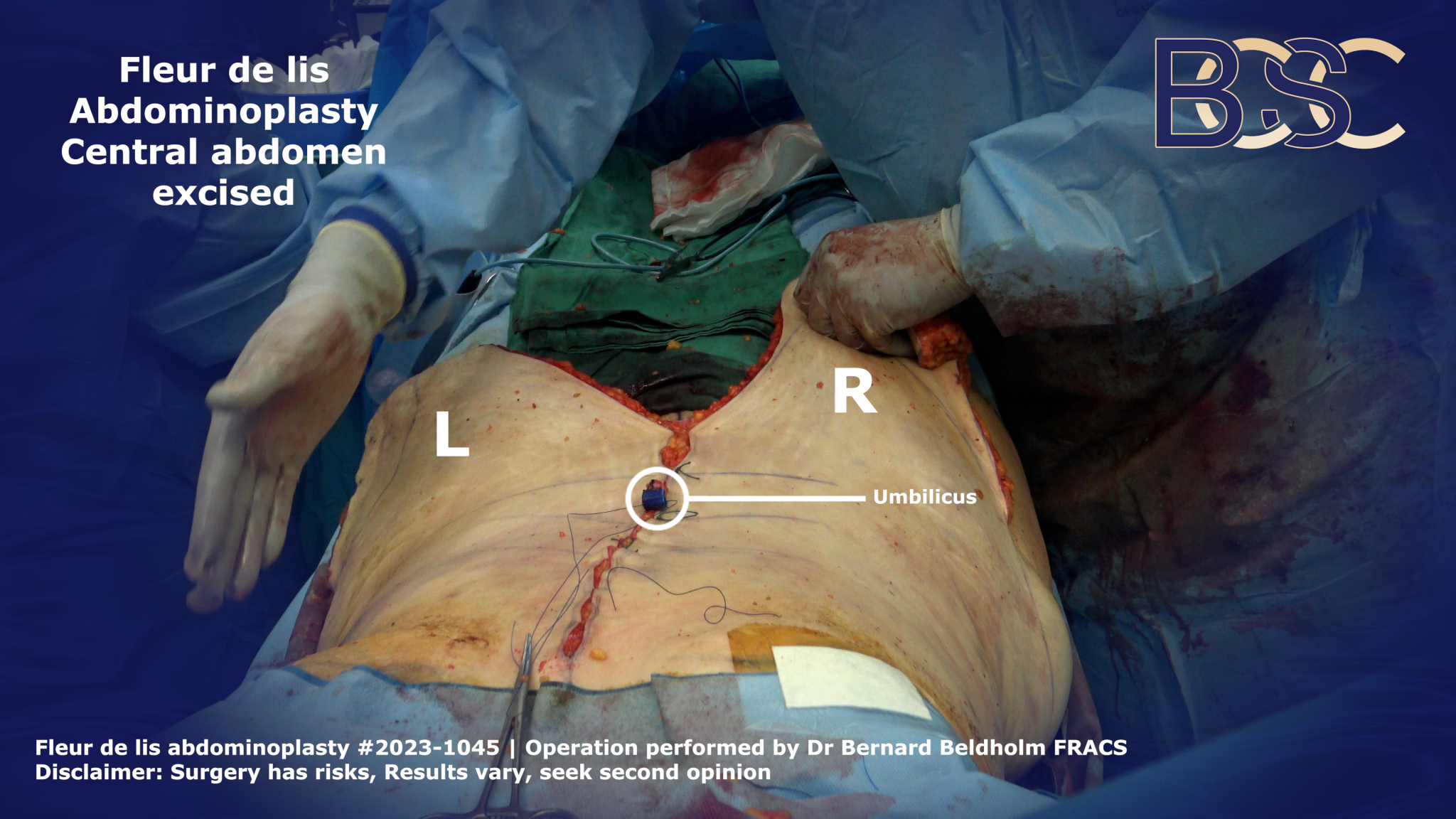 Vertical incision closed in Fleur de lis abdominoplasty | BCSC