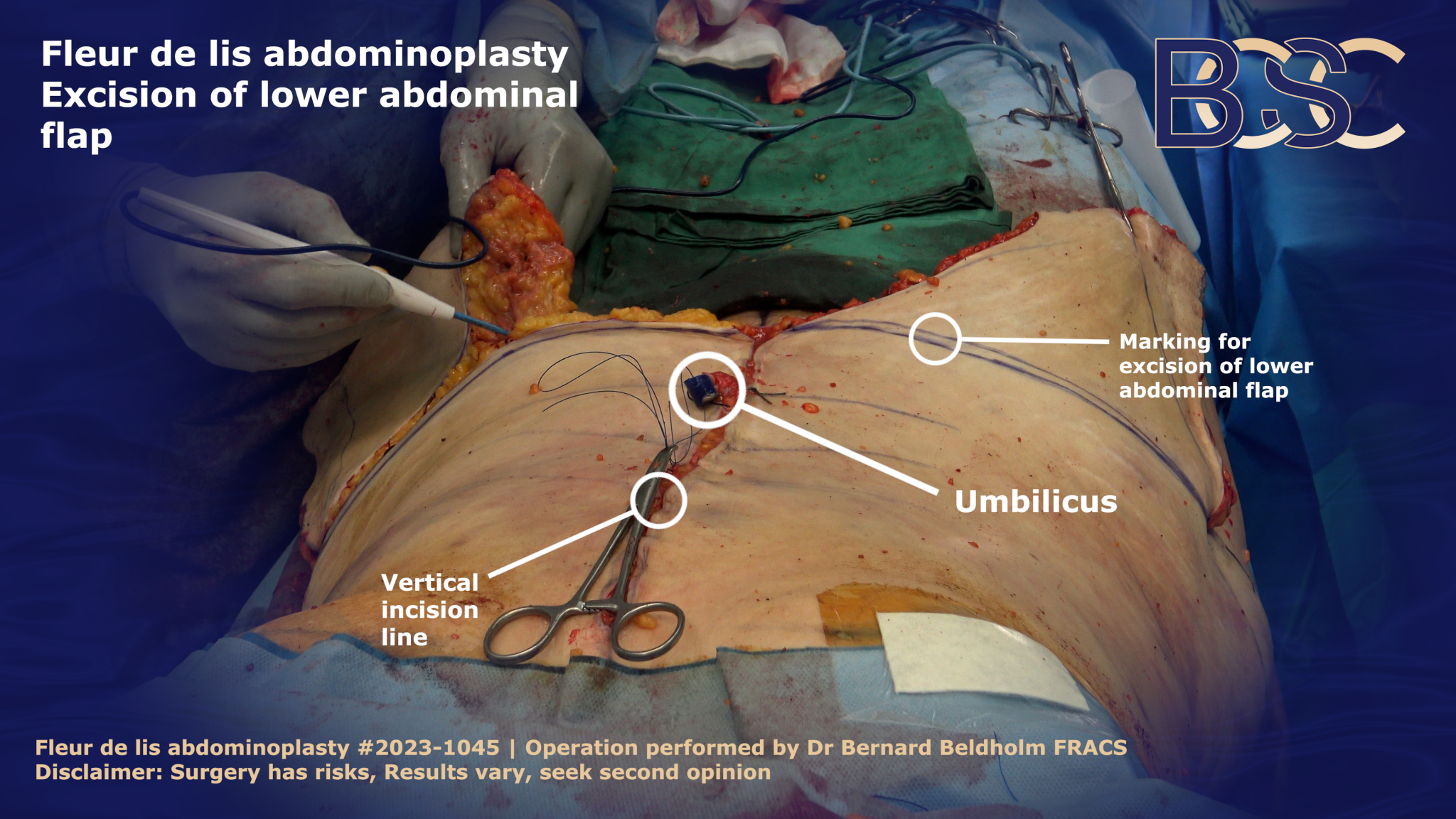 Excision of lower abdominal flap in Fleur de lis abdominoplasty | BCSC