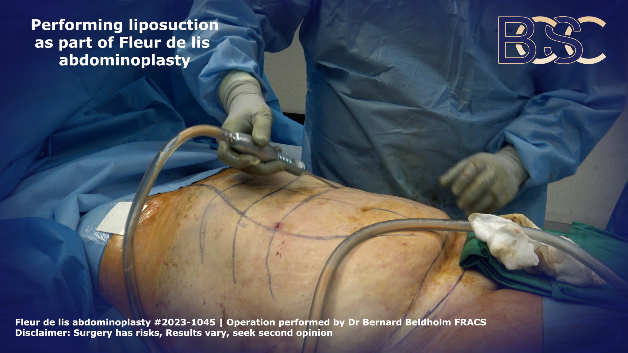 Liposuction as part of Fleur de lis abdominoplasty | BCSC