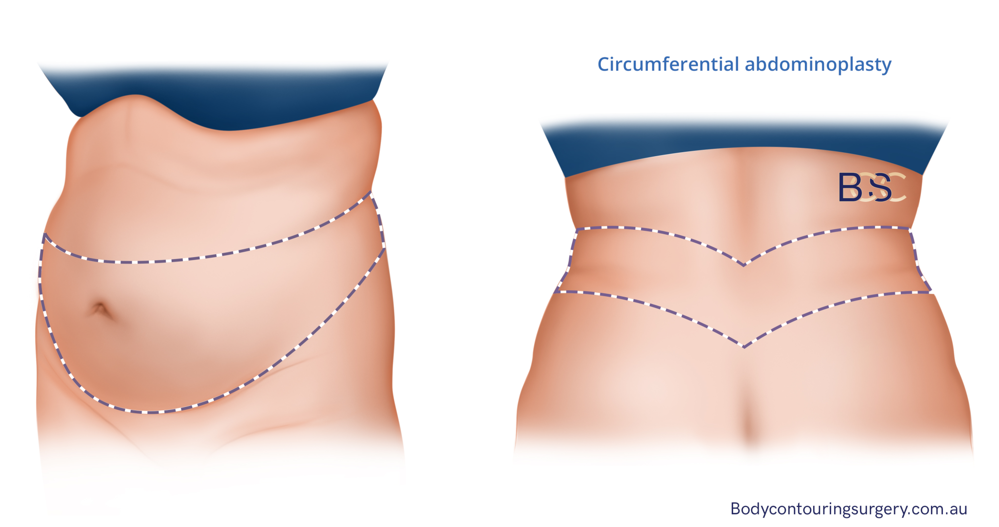Body lift procedures to treat excess skin following gastric bypass surgery. Abdominoplasty Procedure performed by Dr. Bernard Beldholm, pictured, before and 13 months after surgery. 