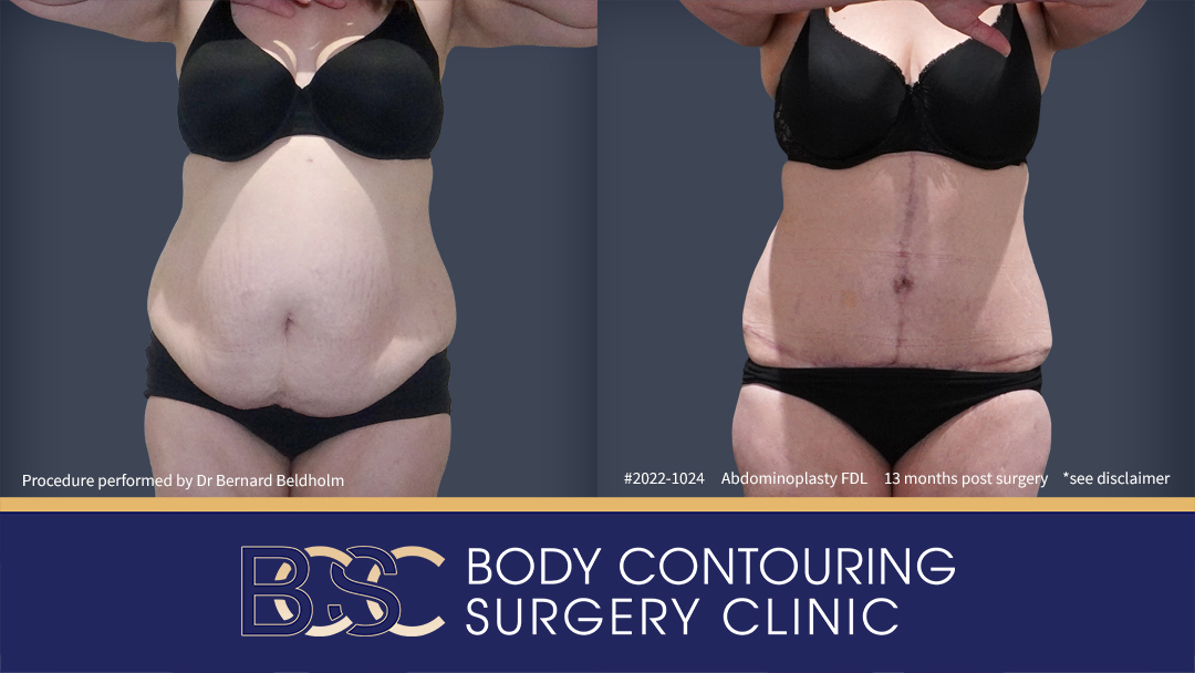 FDL Abdominoplasty Procedure performed by Dr. Bernard Beldholm, pictured, before and 13 months after surgery.