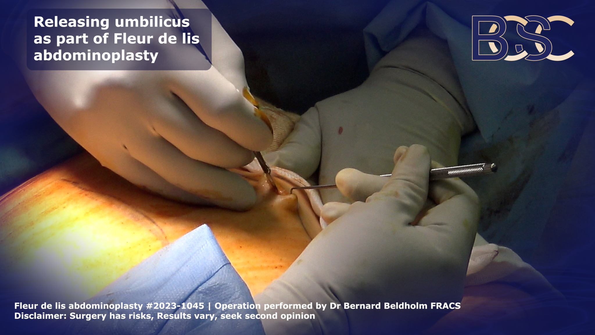 Incision around umbilicus in fleur de lis abdominoplasty | BCSC
