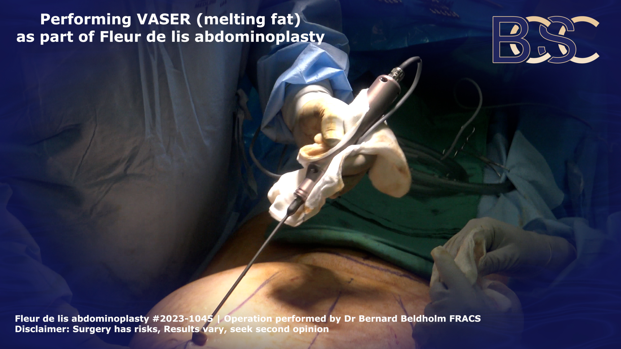 VASER as part of a fleur de lis abdominoplasty | BCSC