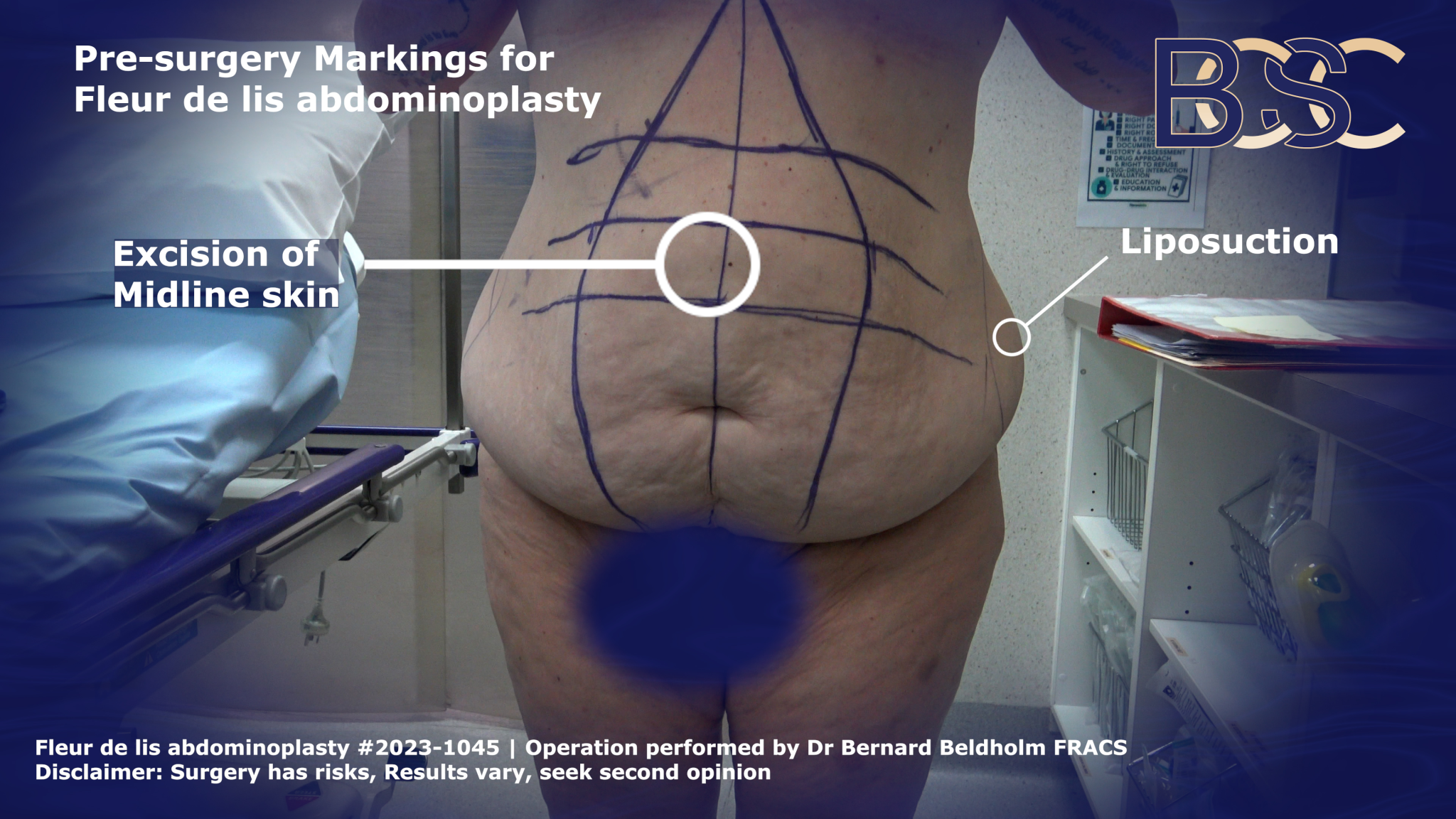 Pre-Surgery markings of excess skin to be removed for fleur de lis abdominoplasty bending over | BCSC