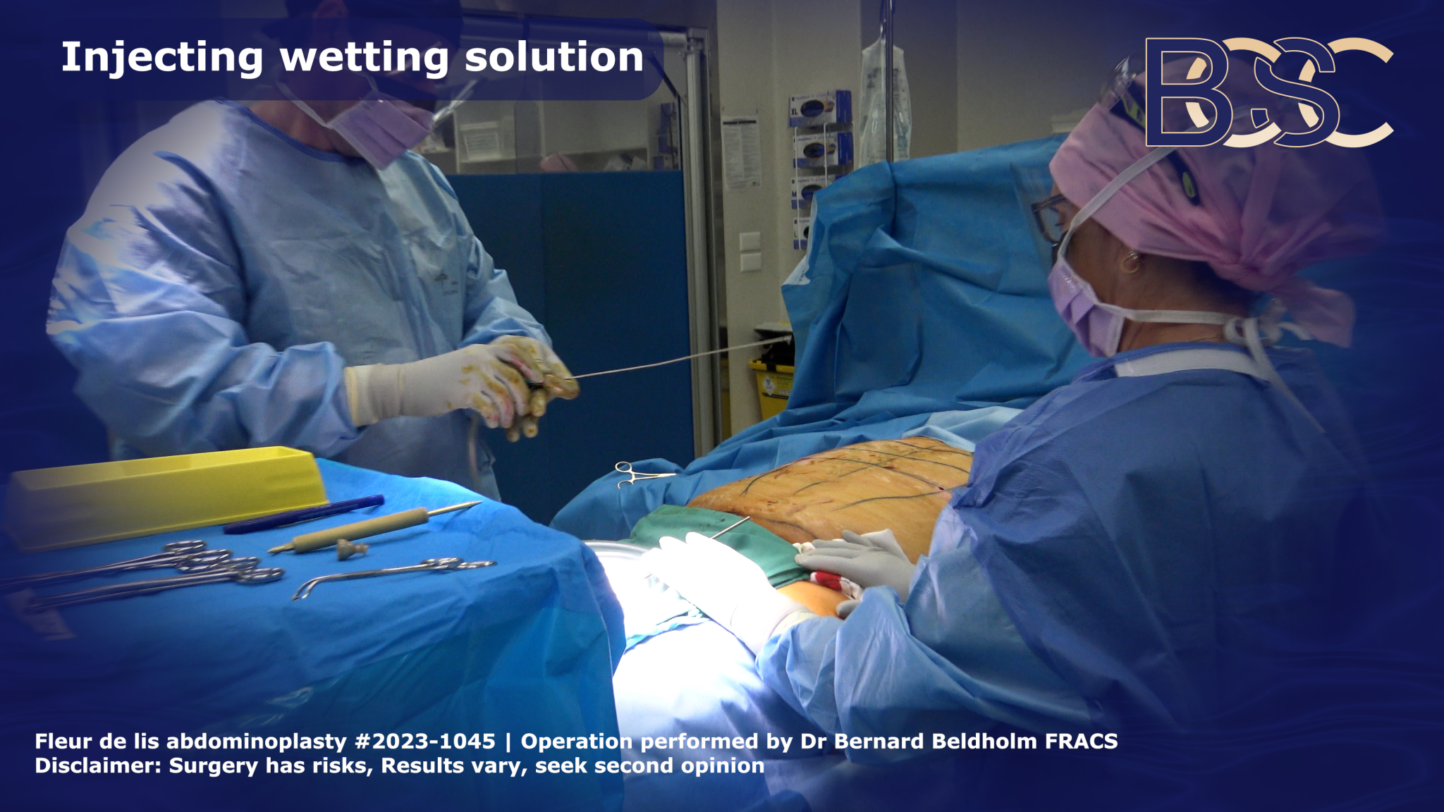 Injecting wetting solution as part of VASER liposuction | BCSC
