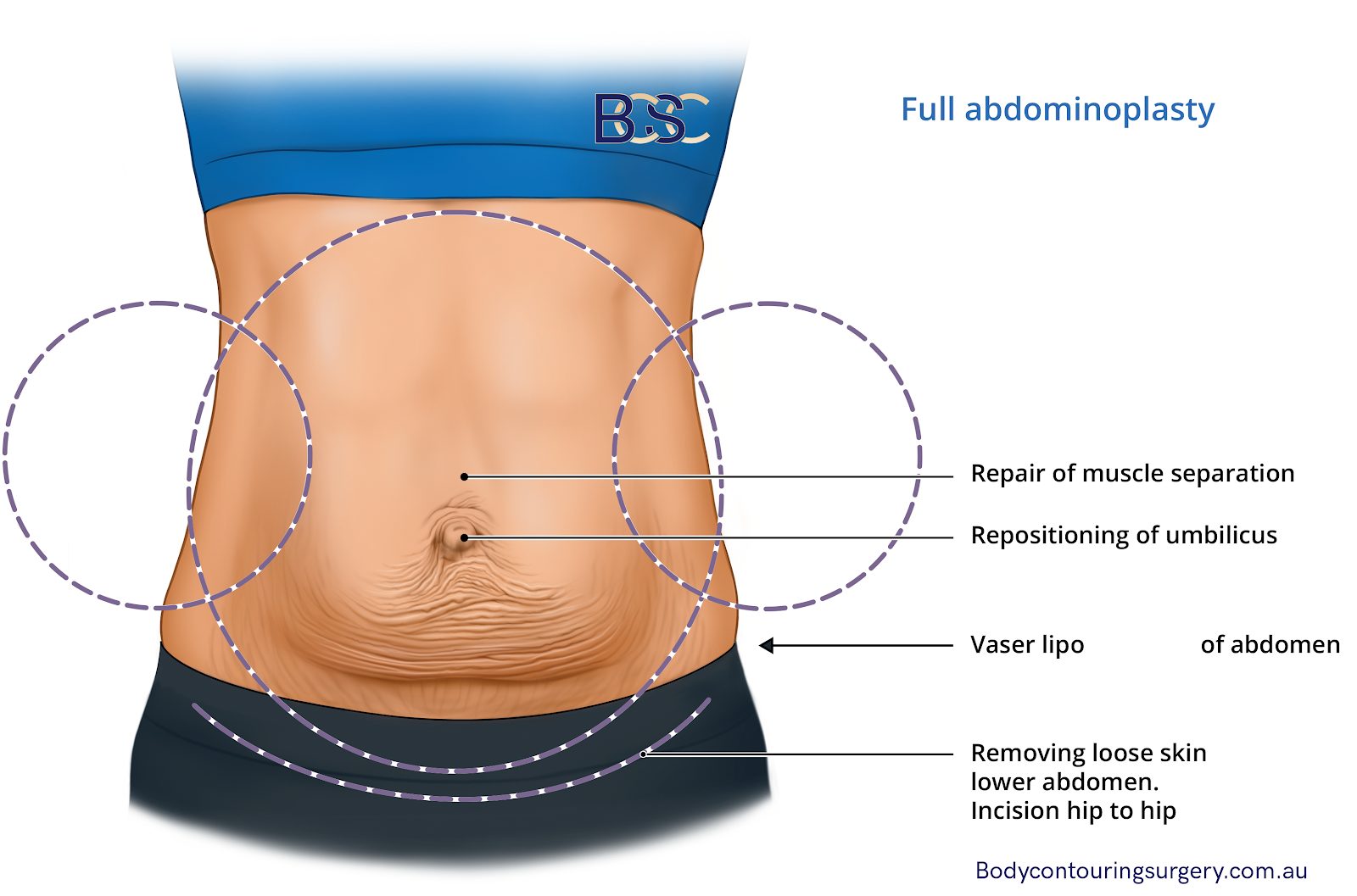 Illustration of Full abdominoplasty